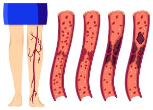 thread_vein_removal