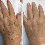 Pigmentation Reduction Tips for Clearer, Healthier Looking Skin