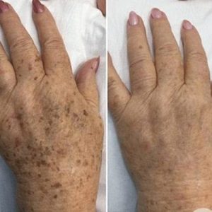 pigmentation reduction